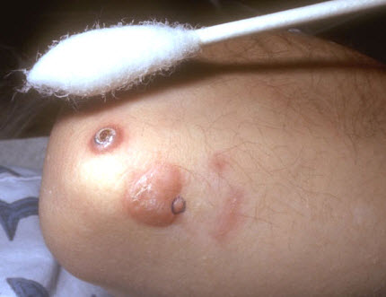 ความปลอดภัยในการทำงานกับไนโตรเจนเหลว (Liquid Nitrogen)